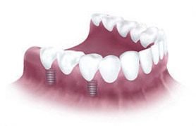 Implanted dentures