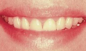 Periodontal After