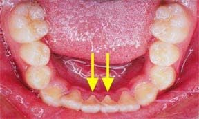 Orthodontic Before