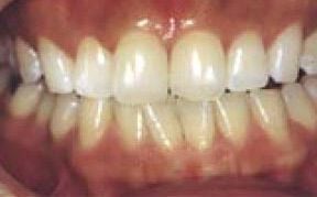 Whitening After