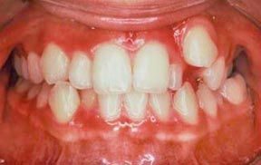 Orthodontic Before