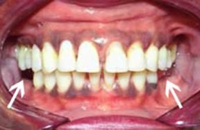 Denture Before