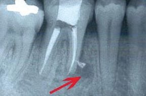 Root Canal Before