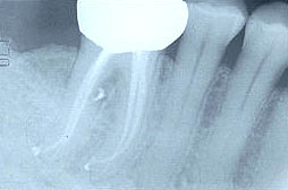 Root Canal After