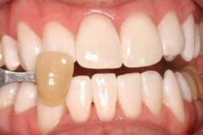 KöR Whitening after