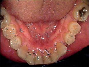 The inside of the lower teeth.