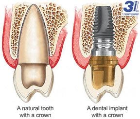 3i Dental Implants