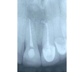 Root Canal After