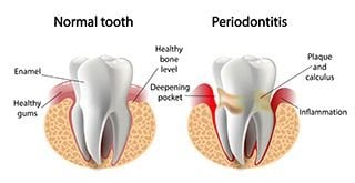 Gum disease treatment Glendale AZ