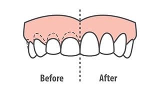 Gum Contouring Vs. Crown Lengthening - Atlanta Smiles