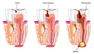 tooth decay