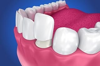 Dental Veneers Charleston