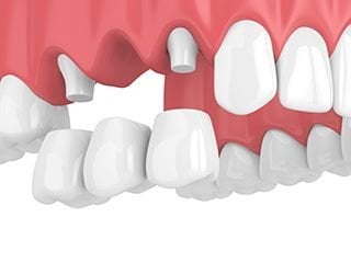 abutment teeth