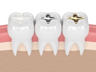 Fillings - Composite, Amalgam, Gold, Porcelain - Carson & Carson, DDS