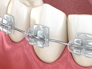 Types of Braces  General and Cosmetic Dentist in Thousand Oaks, CA