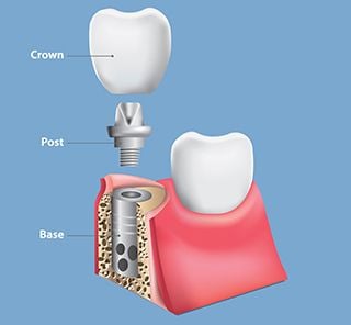 illustration of assembly of parts for dental implant Houston, TX dentist