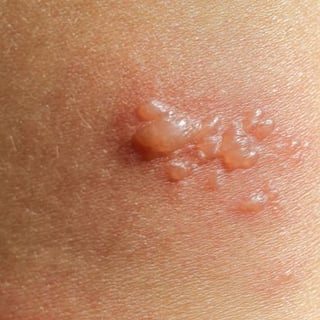 skin blisters that itch