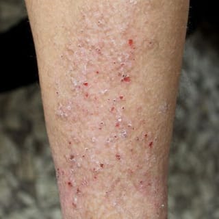 itchy skin on legs