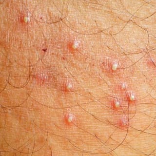 Folliculitis on the left lower breast and submammary area.
