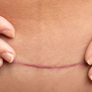 Hypertrophic Scar: Treatment, Causes, Image, and More