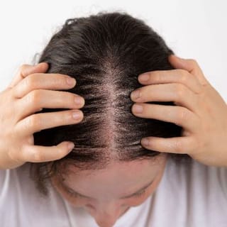 Is My Temporal and Frontal Hair Loss Frontal Fibrosing Alopecia