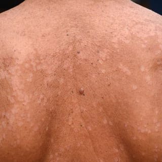 Tinea Versicolor - Walk-in Dermatology