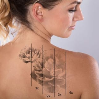 Laser Tattoo Removal  Englewood NJ  Better U Medical Spa  Englewood New  Jersey