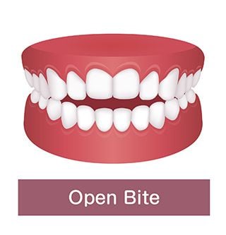 Overjet vs. Overbite: What's the Difference?