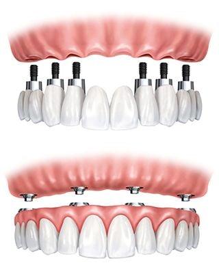 Fixed/Non Removable Teeth on Implants - Hood River, The Dalles, Hermiston –  Your Denture and Implant Specialist