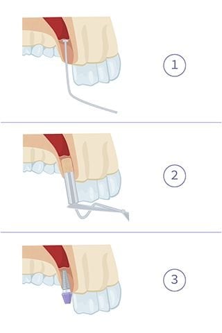 sinus surgery