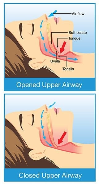 Snoring and sleep deals apnea