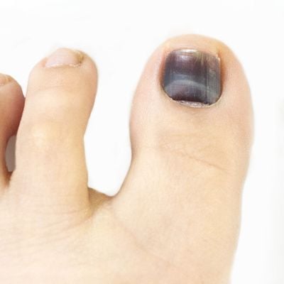 Hematoma Under Nail Photos and Images | Shutterstock