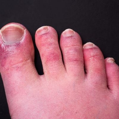 Chilblains (cold feet) - Advance Foot and Ankle