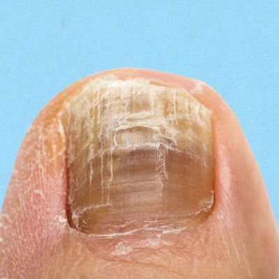 Hydra Naturals Nail Fungus Treatment, Nail Renewal - Maximum Strength Nail  Care Solution for Finger & Toenail Fungus, Athlete's Foot, Ringworm by  Fungus 10ml : Amazon.co.uk: Beauty