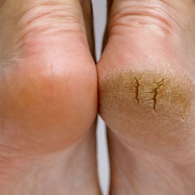 How to heal severely cracked feet - Quora