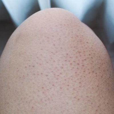 Keratosis Pilaris - Dermatologist in Helena, AR | Jessica Pillow, MD