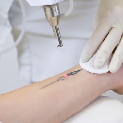Unwanted Tattoos - Dermatologist in Tupelo, MS | Dermatology Center Of  North Mississippi PA