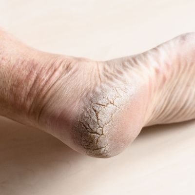 GetUSCart- Dr. Frederick's Original Moisturizing Heel Socks for Cracked  Heel Treatment - 2 Pairs - Stop Cracked Heels in Their Tracks
