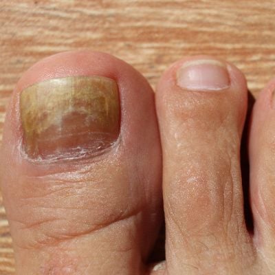Signs and Stages of Nail Fungus Progression by Caratin Rx - Issuu