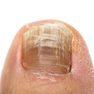 Nail Treatment Essence Serum Care Hand And Foot Care Nail Fungus Treatment  Essence Nails Restore Nail Shine Nail Repair Oil | Fruugo SA