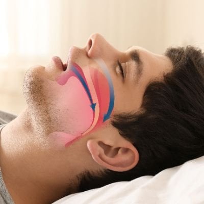 Sleep Apnea Surgery - Florida Otolaryngology Group