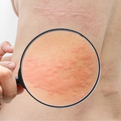 What Causes Hives? - Sharecare