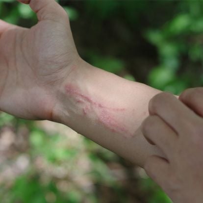 poison sumac rash on hands