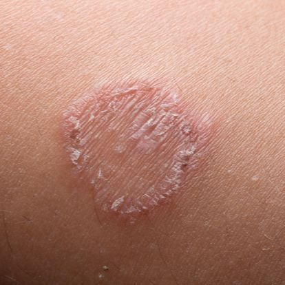 Ringworm (Tinea Corporis) Condition, Treatments and Pictures for Teens -  Skinsight
