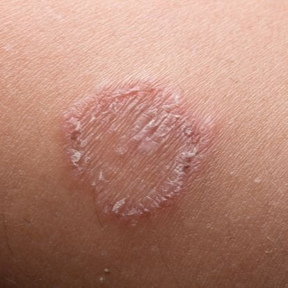 Ringworm (Tinea Corporis) - Blue Harbor Dermatology