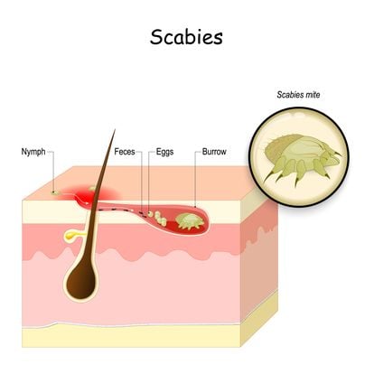 Scabies - Dermatologist Medical Group of North County