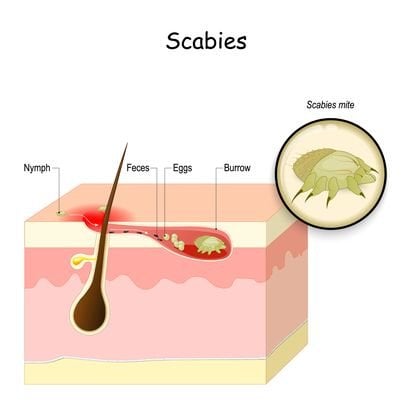 scabies mite