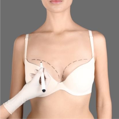 Options for Droopy Breasts – Breast Lift, Implants or Both