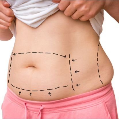 Tummy Tuck, Plastic Surgeon In 