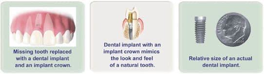 3i Dental Implant examples